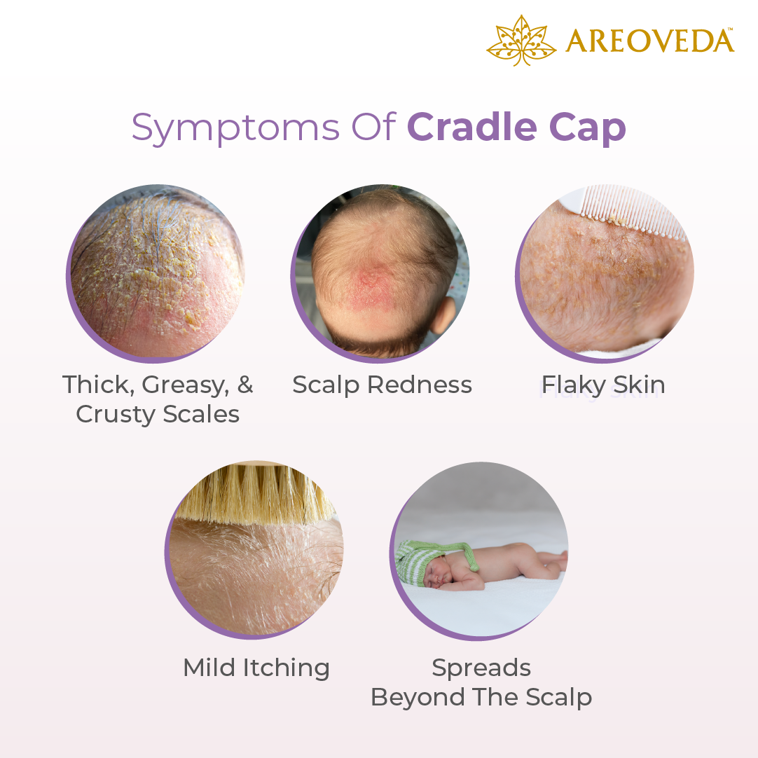 What does cradle cap look like?